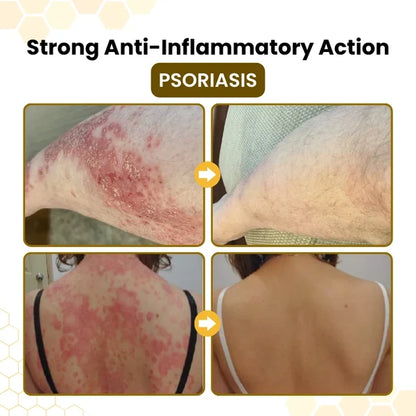 PsoriaSoothe Bee Venom Rescue Cream